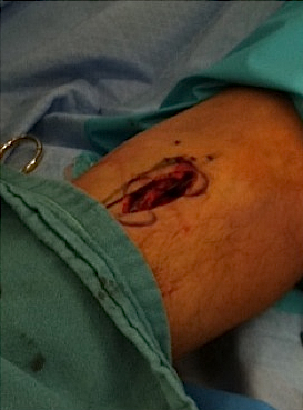 Distal Biceps Repair Incision